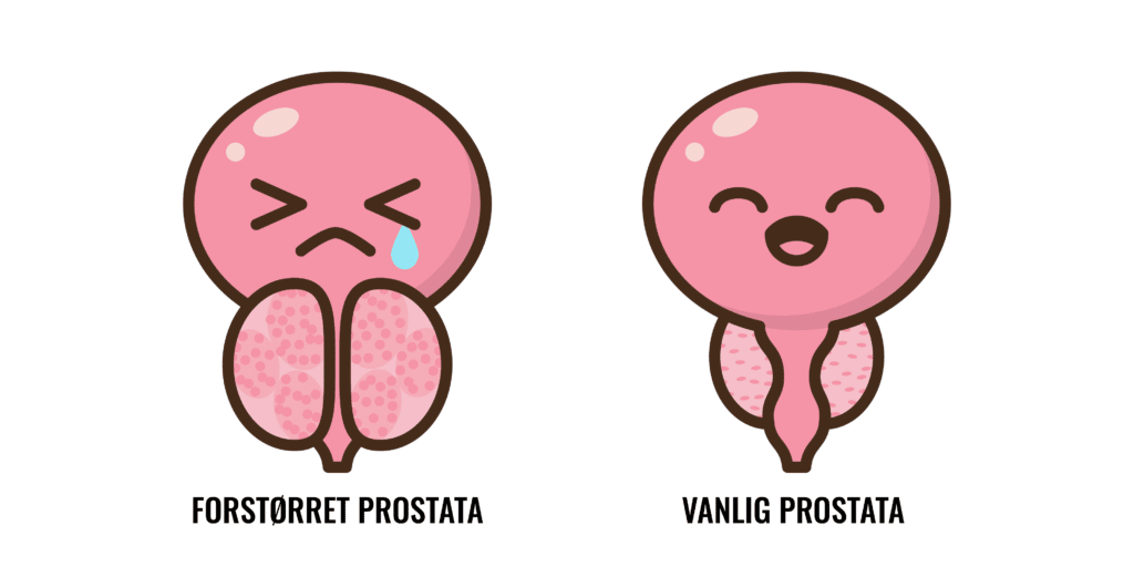 forstørret prostata